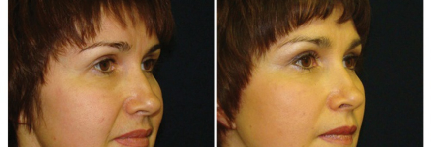 Фейслифтинг