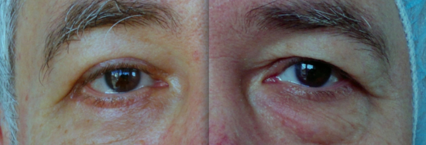 Блефаропластика 