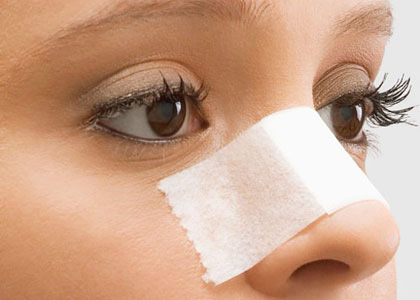 Отеки после ринопластики: как быстрее восстановиться