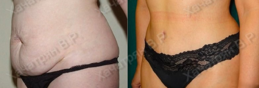 Абдоминопластика