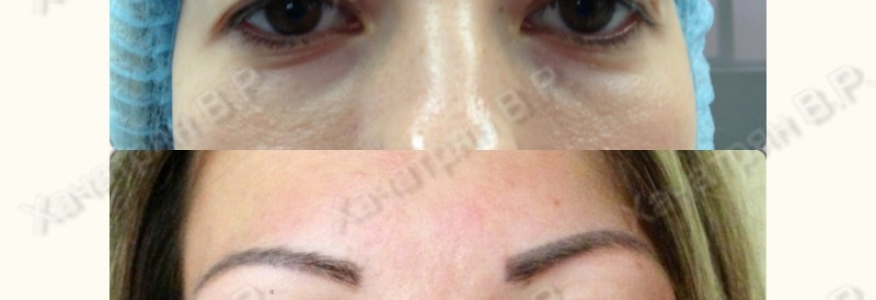 Блефаропластика 