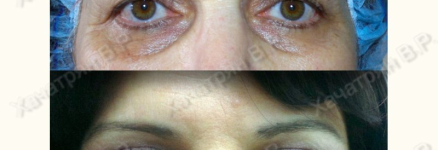 Блефаропластика 