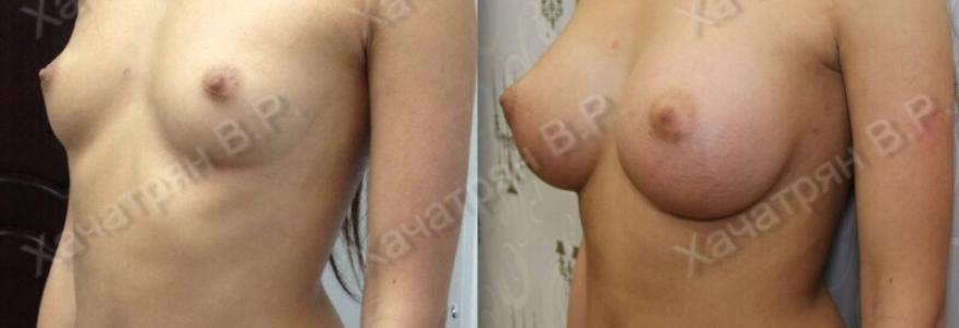 Увеличение груди