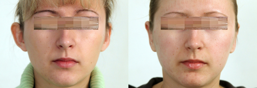 ОТОПЛАСТИКА