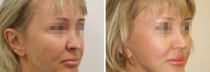 Фейслифтинг