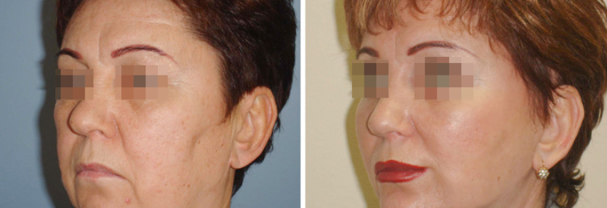 Фейслифтинг