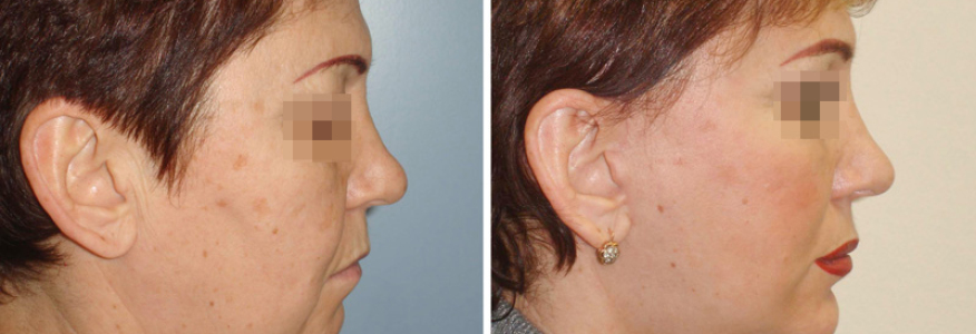 Фейслифтинг