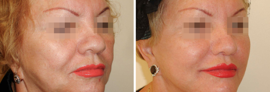 Фейслифтинг