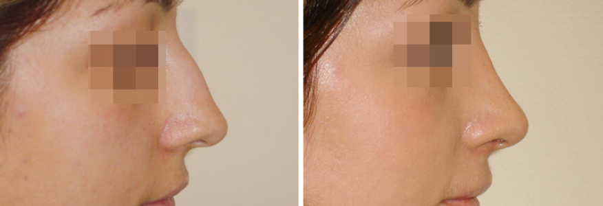 Ринопластика