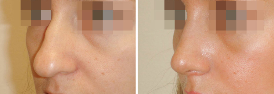 Ринопластика