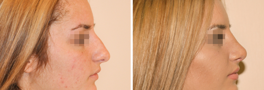 Ринопластика 