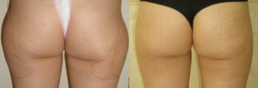 Липосакция бедер