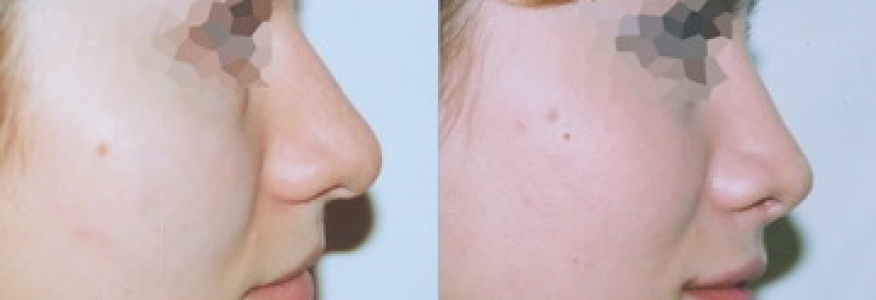 Ринопластика