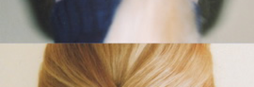 Отопластика - коррекция лопоухости