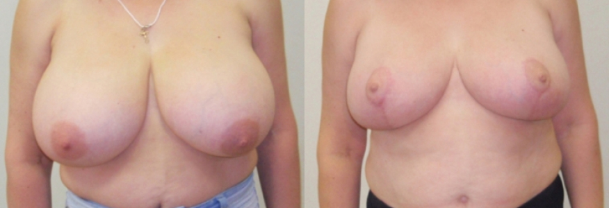 Уменьшение груди