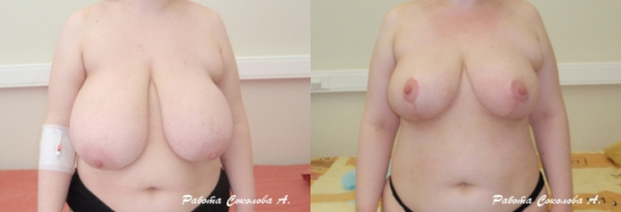 Уменьшение груди