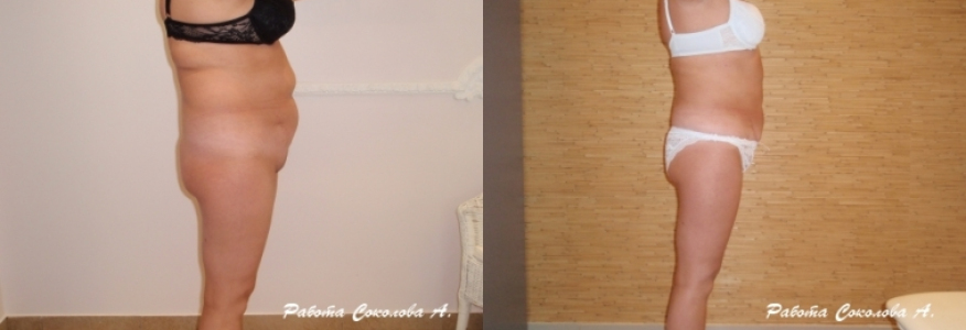 Липосакция