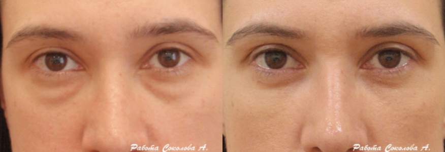 Блефаропластика 