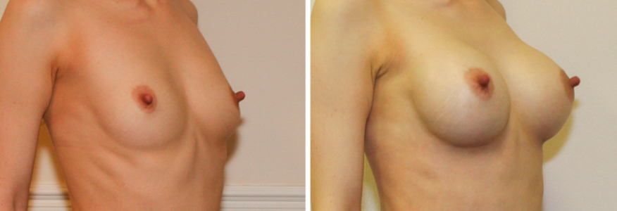 Увеличение груди