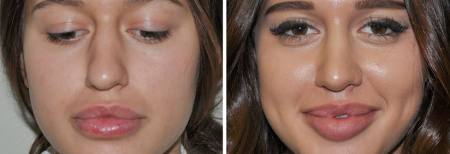 Ринопластика 