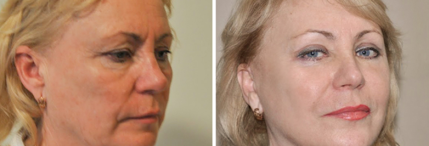 Фейслифтинг