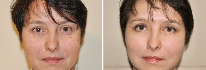 Фейслифтинг