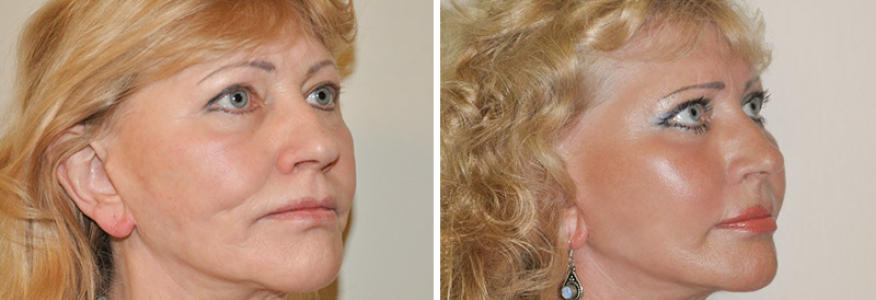 Фейслифтинг