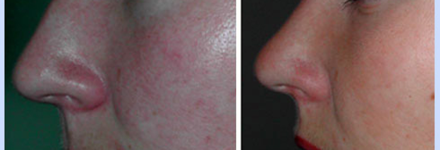 Ринопластика