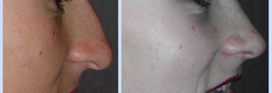 Ринопластика 