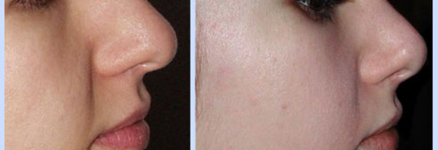 Ринопластика 