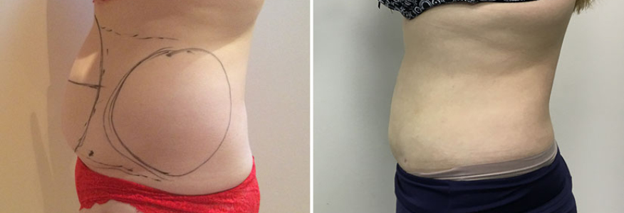 Липосакция