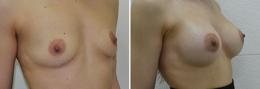 Увеличение груди