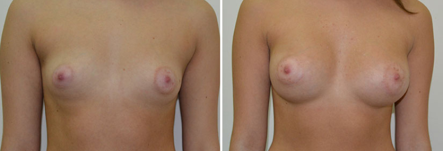 Увеличение груди