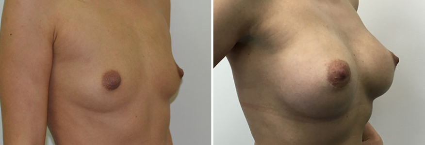 Увеличение груди