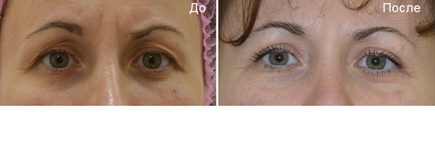 Блефаропластика