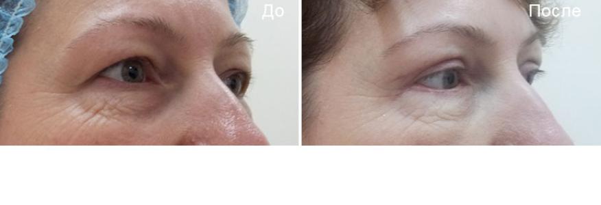 Блефаропластика