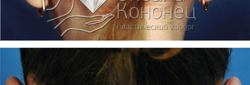 ОТОПЛАСТИКА