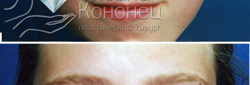 ОТОПЛАСТИКА