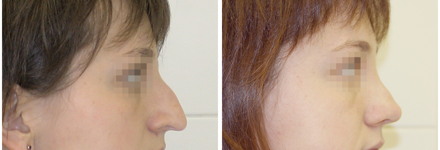 Ринопластика