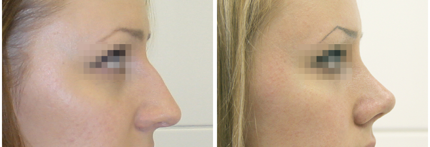 Ринопластика