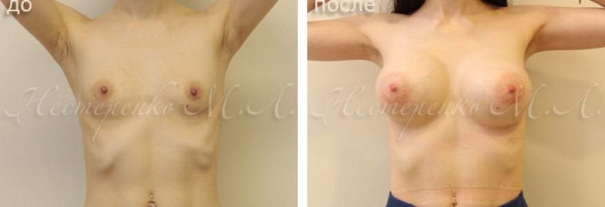 Пациентке установлены круглые имплантаты Allergan Natrelle TRF325, рост 164 см.
На фото пациентка до и через 9 месяца после операции.
Отмечается изначальная асимметрия ареол (левая ниже правой). От уменьшения ареол и устранения асимметрии пациентка отказалась, вследствие необходимости дополнительной операции.