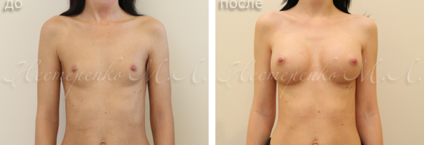 Пациентке установлены анатомические имплантаты Allergan Natrelle МF 295 г, рост 163 см, грудная клетка 65 см.