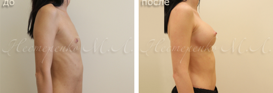 Пациентке установлены анатомические имплантаты Allergan Natrelle МF 295 г, рост 163 см, грудная клетка 65 см.