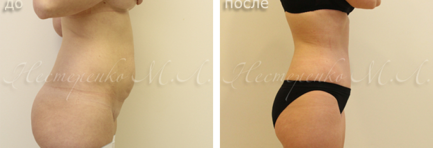 Фото пациентки до и через 6 месяцев после абдоминопластики. Устранен диастаз (расхождение) прямых мышц живота. П.оявилась талия.