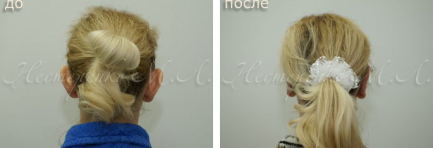 Фото пациентки до и после пластики ушей.