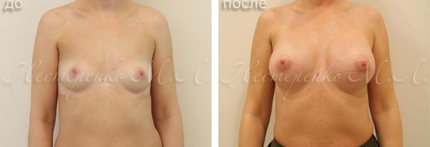 Пациентке установлены имплантаты Allergan Natrelle MF375, рост пациентки 165 см. 
На фото пациентка до и через 5 месяцев после операции.