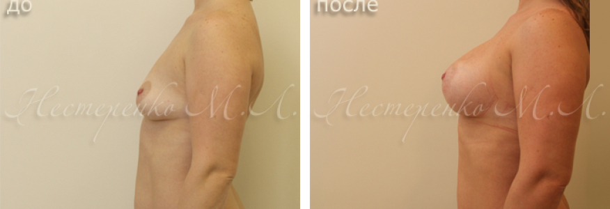 Пациентке установлены анатомические имплантаты Allergan Natrelle МХ410, рост 165 см.
На фото пациентка до и через 10 месяцев после операции.