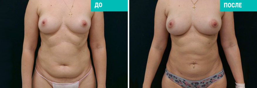 Липофилинг груди