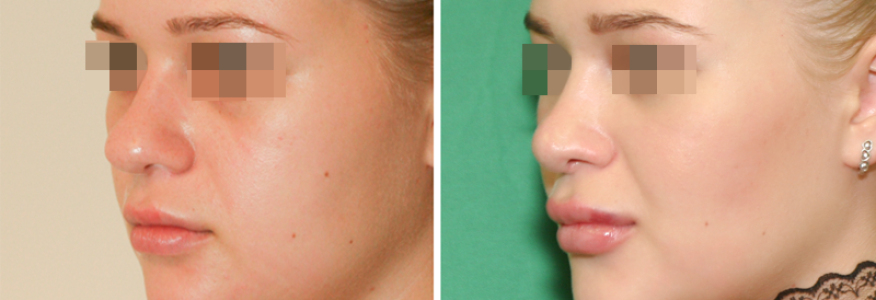 Ринопластика 