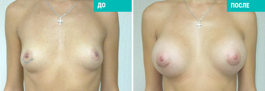 Увеличение груди